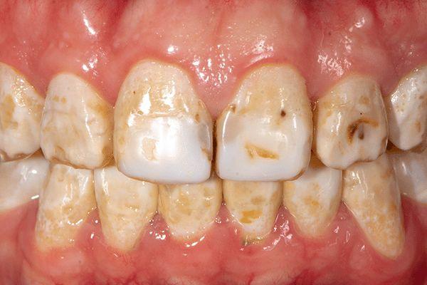 दांतों के पीलेपन से बचाव (Prevention of Yellow Teeth)