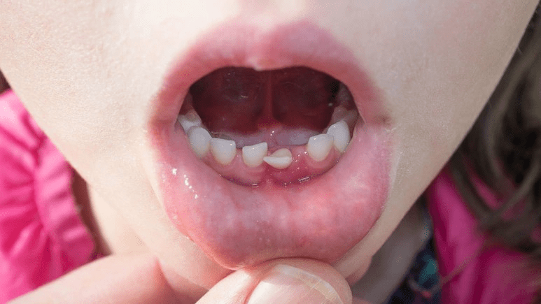 Permanent Teeth निकलने में बच्चों को समस्या क्यों होती है?