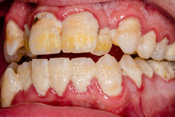 दांतों के पीलेपन के लक्षण 2025 उपचार और बचाव yellow teeth solution