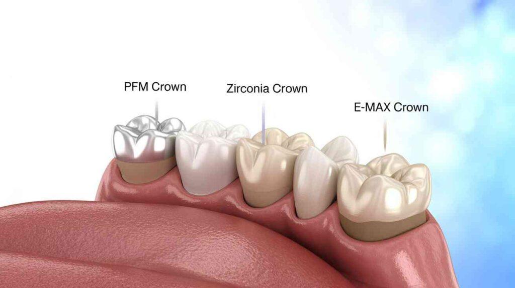 डेंटल crown की ज़रूरत किसी को भी पड़ सकती है – चाहे cavity बहुत गहरी हो, root canal treatment के बाद दाँत को strength चाहिए, या फिर tooth fracture हो गया हो। लेकिन PFM Crown vs Zirconia vs E-max जब Dentist आपको crown लगाने की सलाह देते हैं, तो सबसे बड़ा सवाल यही होता है...