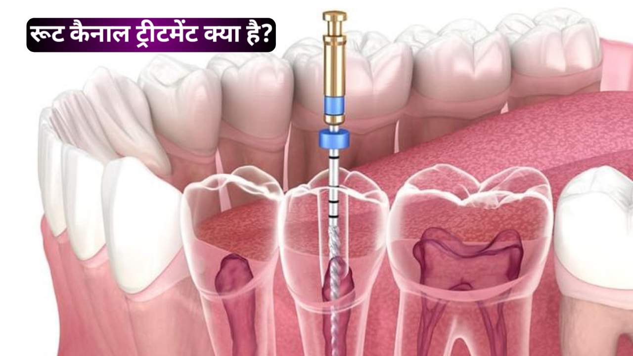 Root canal treatment क्या होता है इसे करवाने में कितना खर्च लगेगा