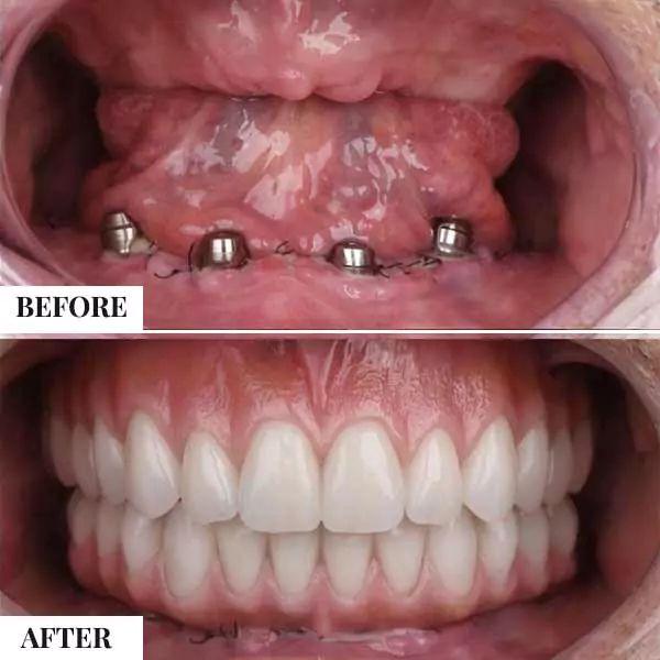 क्या डेंटल इंप्लांट एक लाभदायक इलाज है ? जानिए Dental implants के बारे में ।