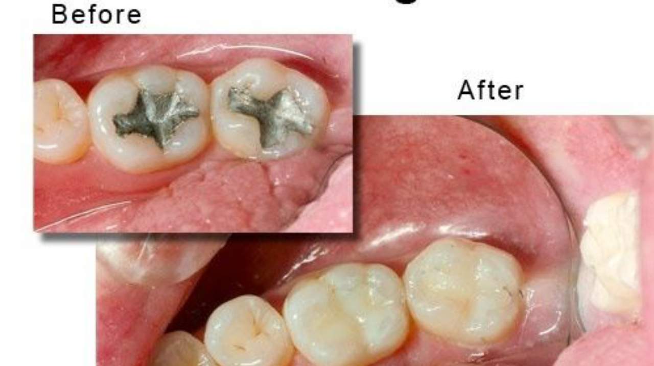 dental filling pain after treatment , tooth filling कितना टिकाऊ है,