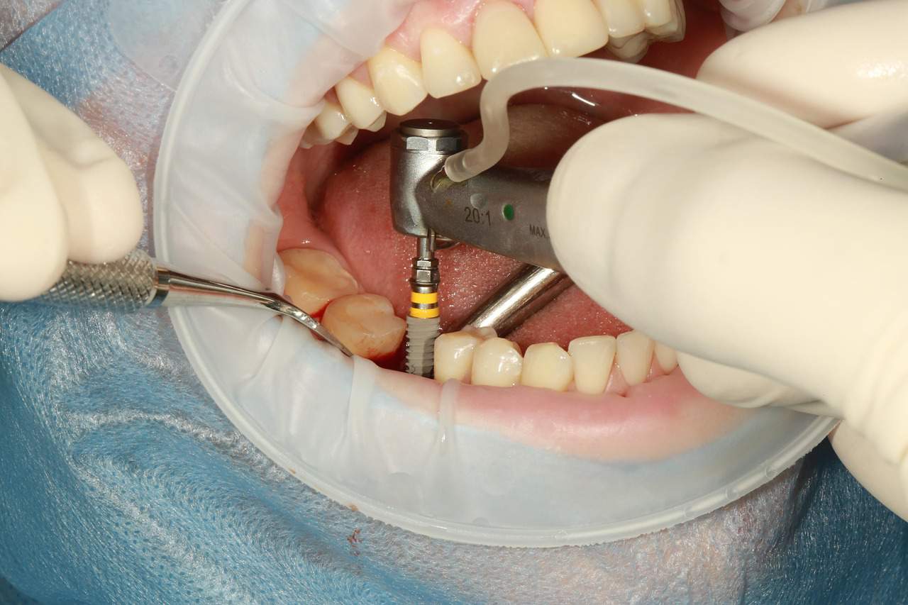 Dental implants work , implant treatment में कितना खर्च लगता है और इसे कैसे किया जाता है ।