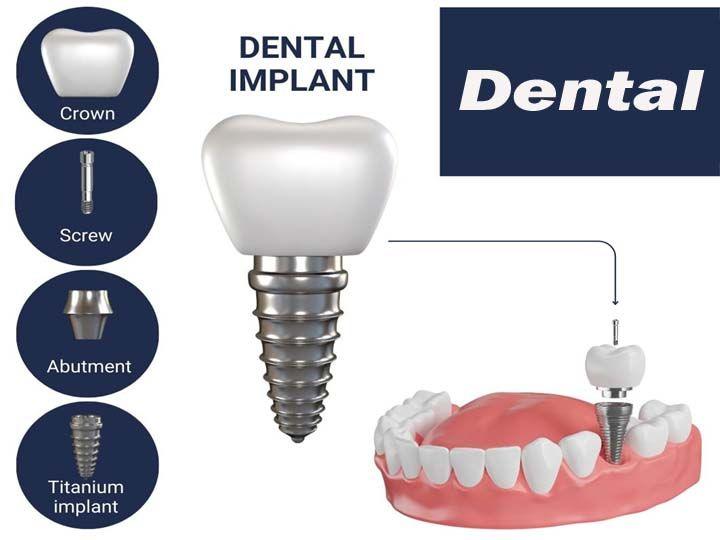 Dental implants लगवाने में कितना खर्च हो सकता है, क्या यह लाभदायक है ?