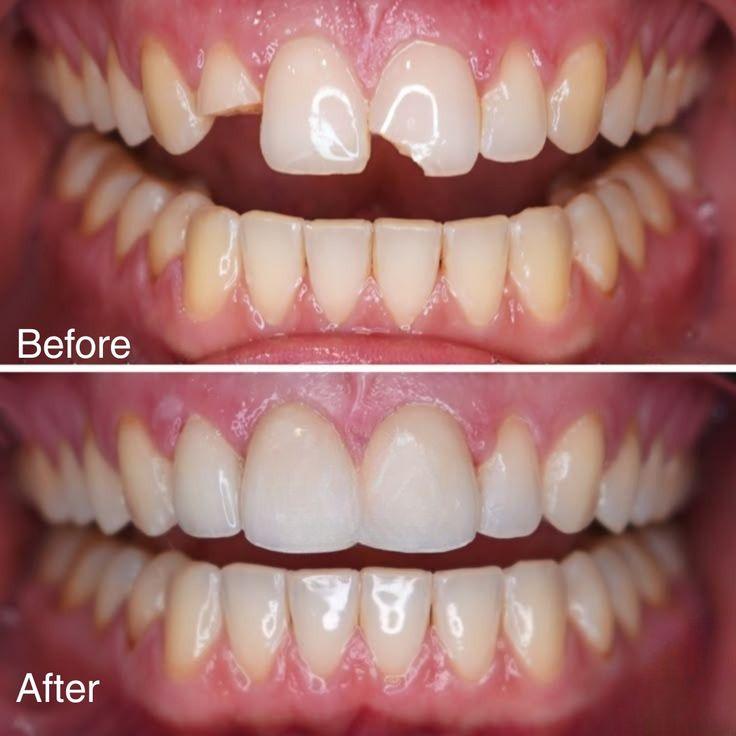Dental filling in mouth by dentist, दांत के कैविटी को फिलिंग कैसे होता है 