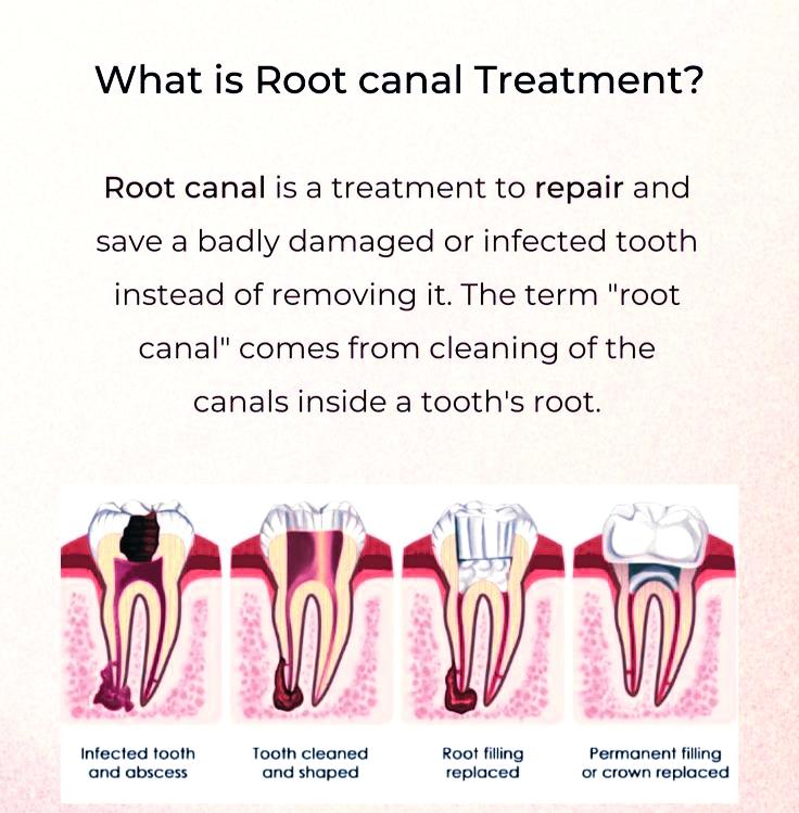 Root canal treatment क्या होता है इसमें कितना खर्च होगा।