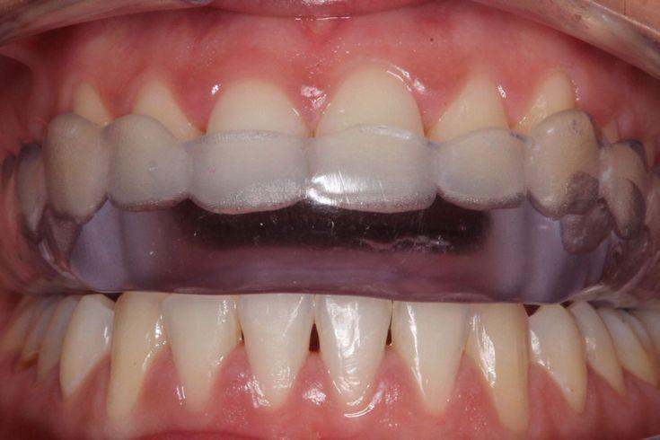 Mouthguard क्या है और यह कैसे काम करता है?, इसे इस्तेमाल करने के तरीके और खर्च की जानकारी।