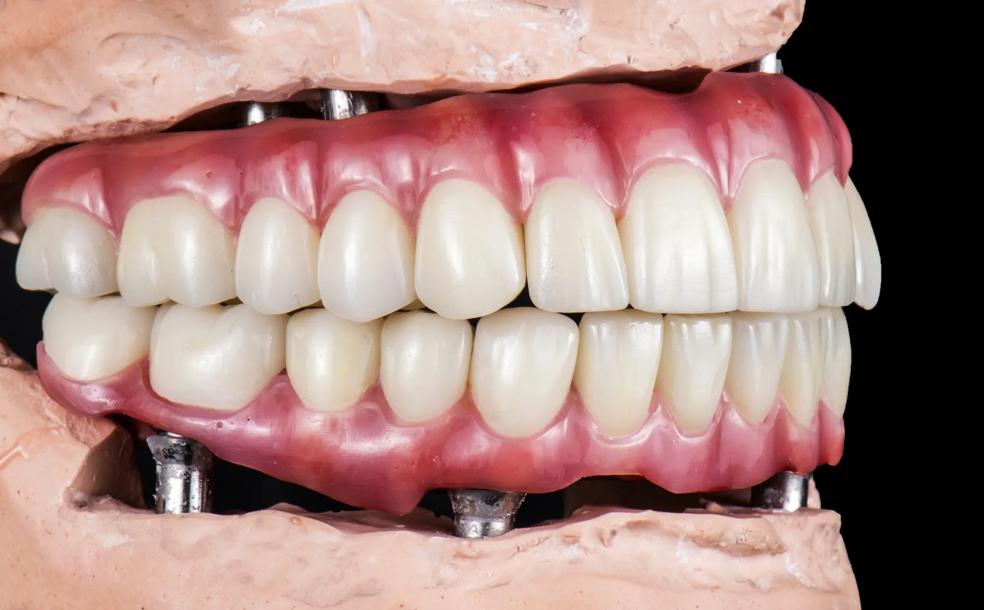 Dental Lab Services, fast turnaround in UjoDent Laboratory